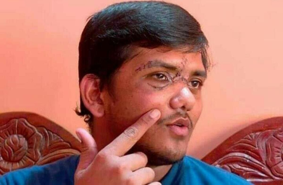 Soldier H N Mahesh shows the injury he received while on duty in Kashmir.
