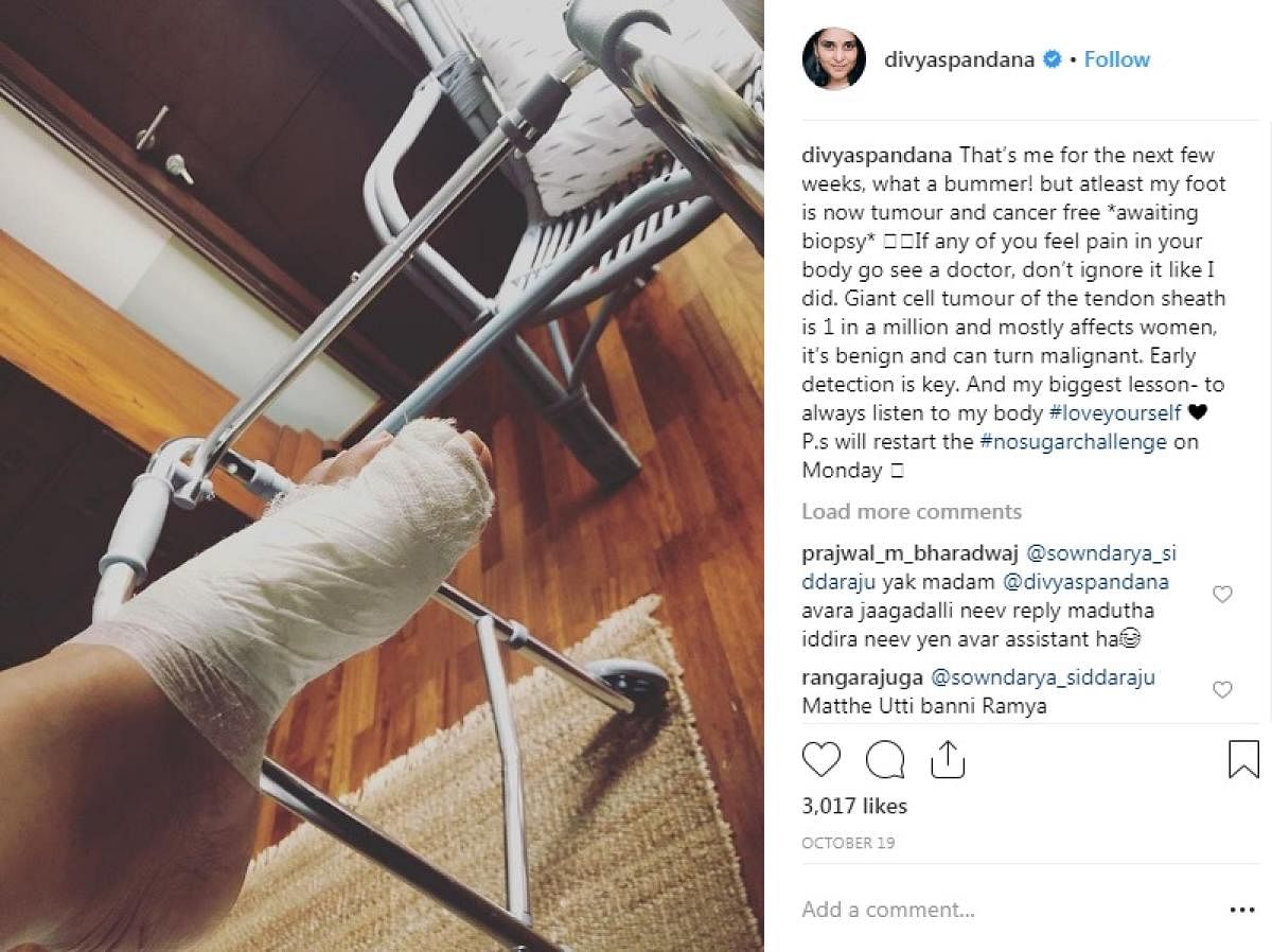 Actress Ramya aka Divyaspandana posted the picture of her injured leg on Instagram. 