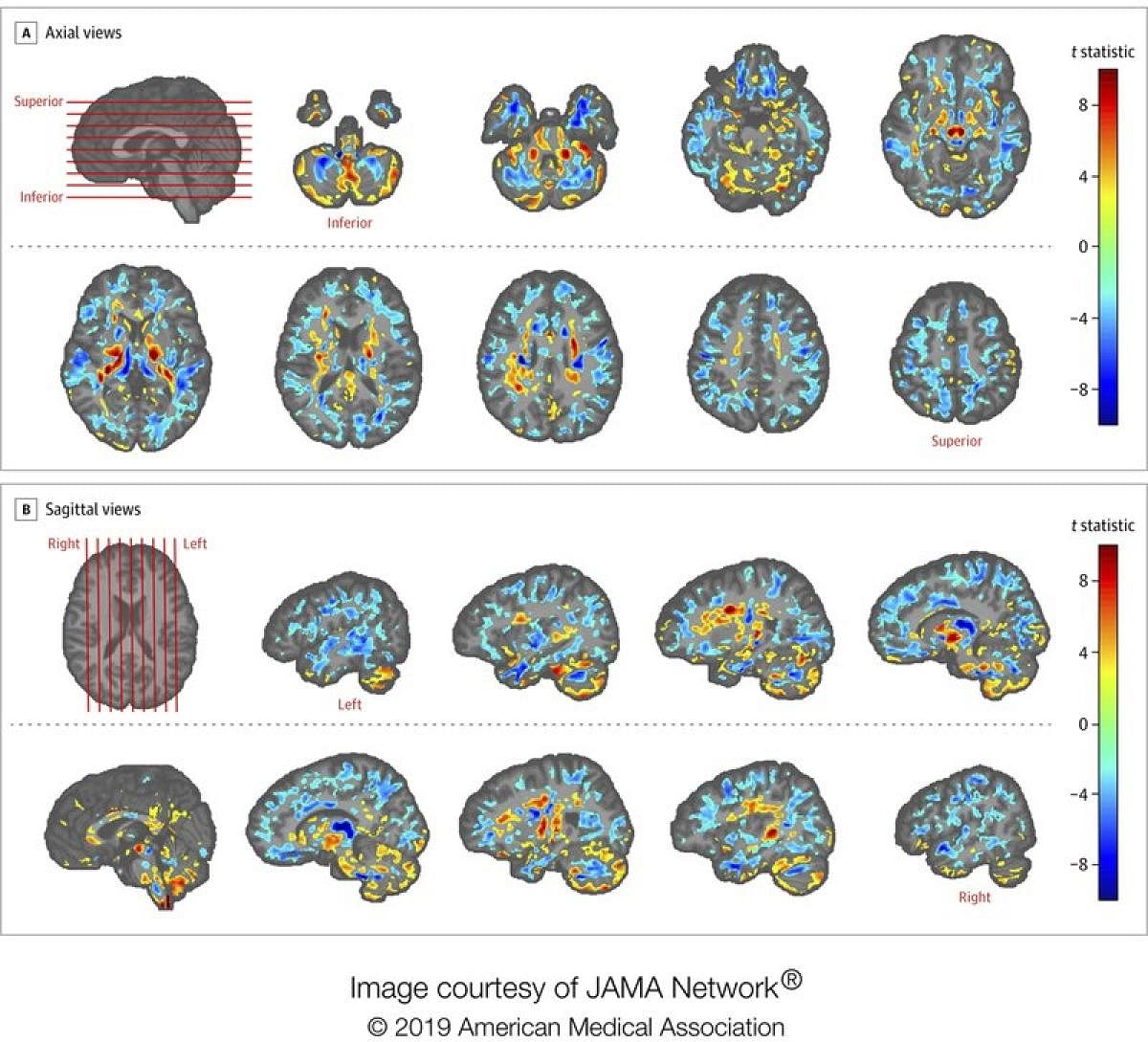 his image provided by the American Medical Association in July 2019 shows the amount of differences between brain scans of patients, U.S. diplomats who developed concussion-like symptoms after working in Cuba, and a control group. Between late 2016 and May 2018, several U.S. and Canadian diplomats in Havana complained of health problems from an unknown cause. One U.S. government count put the number of American personnel affected at 26. (AP Photo)