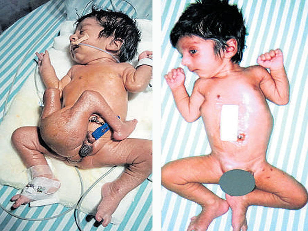 The infant before (left) and after surgery (right).