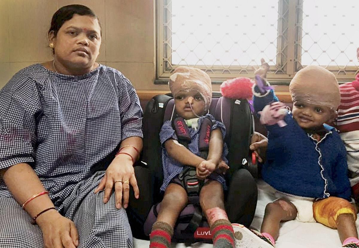 The conjoined twins from Kandhamal district of Odisha, Jaga and Kalia with their mother. PTI file photo