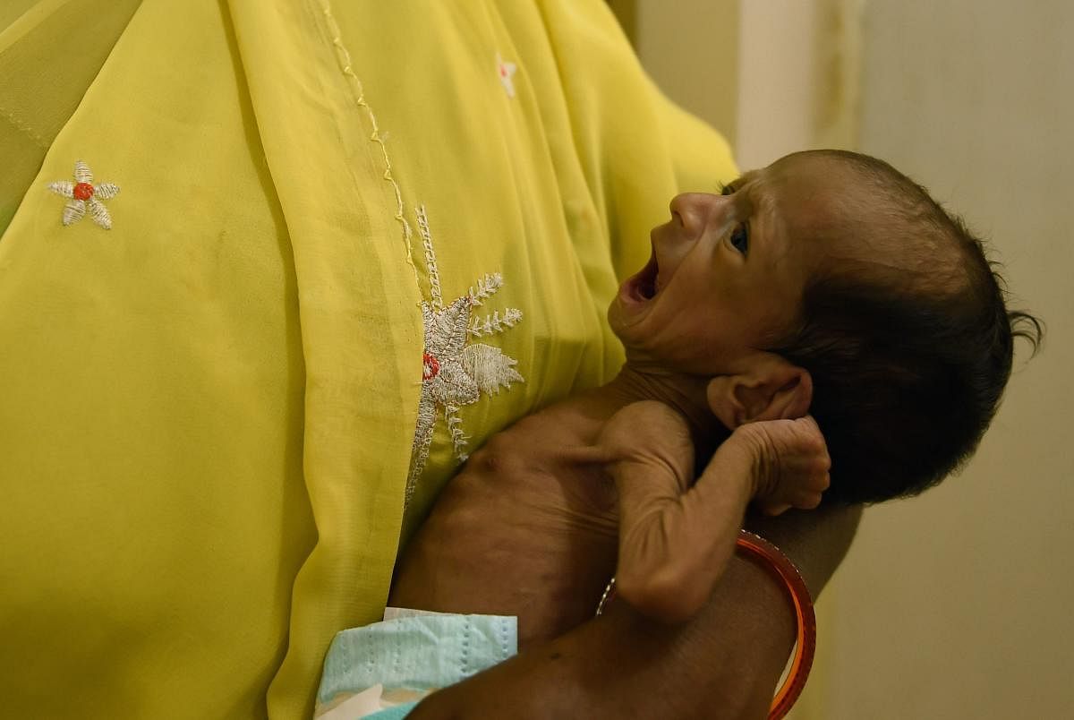 A malnourished baby is attended to by a nurse at the special newborn care unit in a hospital.