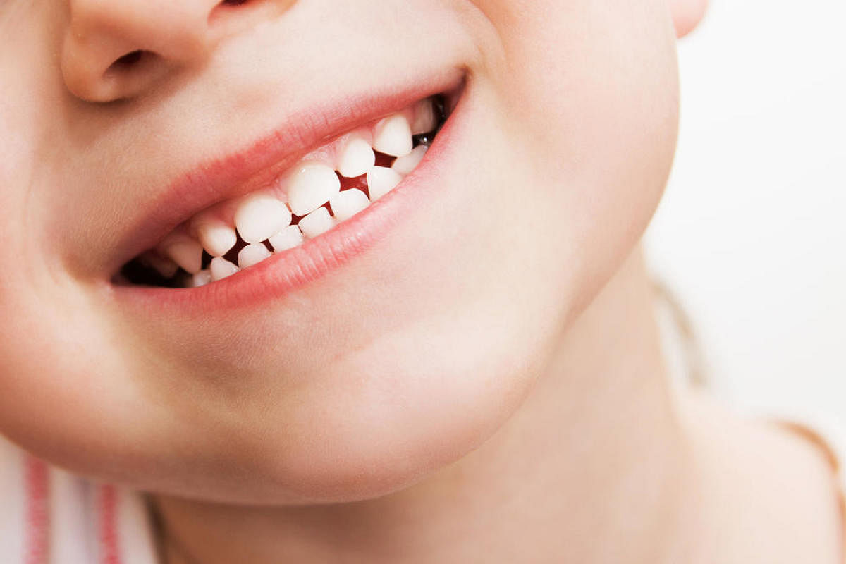 Some of the major oral health problems found in children surveyed include visible plaque accumulation, white spots on teeth, visible caries, gum inflammation, bad breath and gum bleeding.
