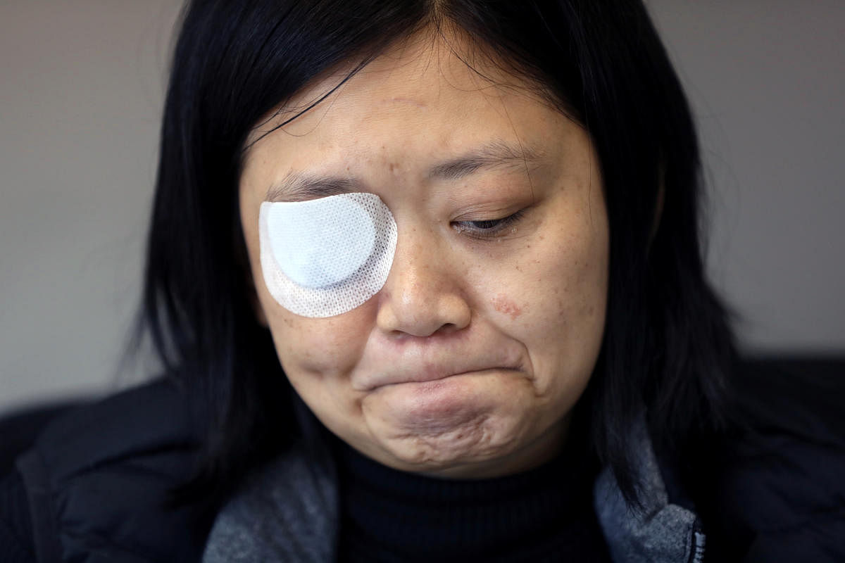 Indonesian journalist Veby Mega Indah, whose right eye was severely injured by Hong Kong police during a protest, becomes emotional recalling the incident during an interview with Reuters in Hong Kong, China. (Photo by Reuters)