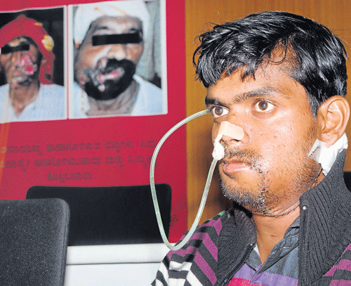 A victim of tobacco addiction, 21-year-old Salahuddin Mulla from West Bengal, at a media briefing in Bangalore on  Tuesday. DH Photo