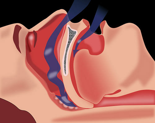 Obstructive sleep apnea (OSA) or obstructive sleep apnea syndrome is the most common type of sleep apnea and is caused by obstruction of the upper airway.Wiki Image