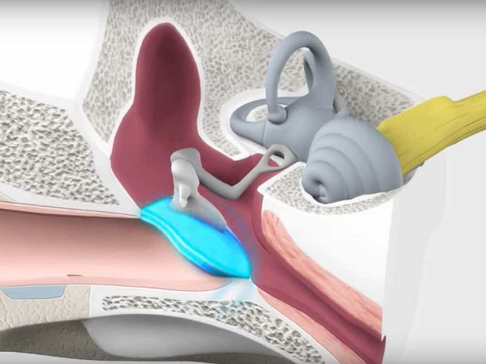 Cochlear implants are tiny electronic devices that are inserted into the ears of deaf kids to restore hearing.  Screengrab from video posted on youtube by Advanced Bionics