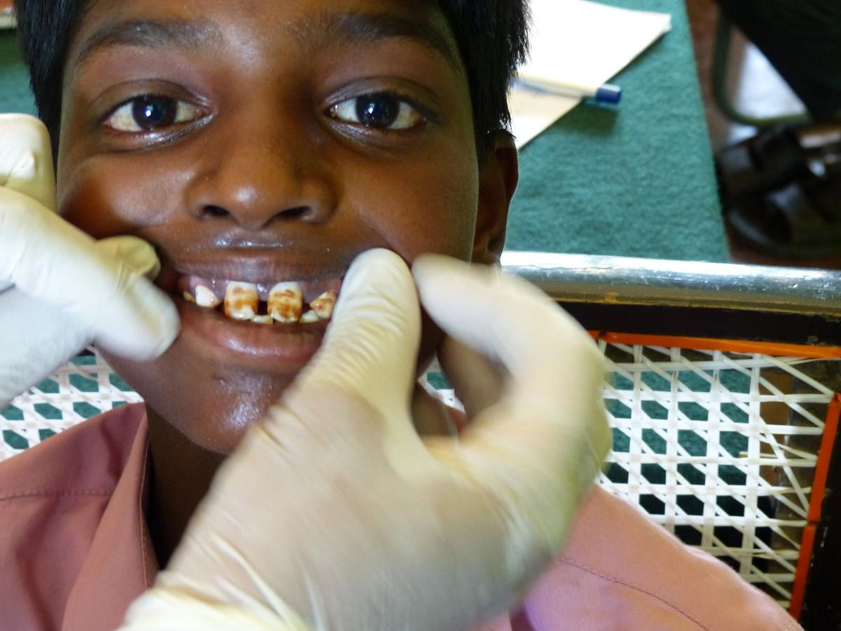 A boy from Pavagada affected by dental fluorosis.