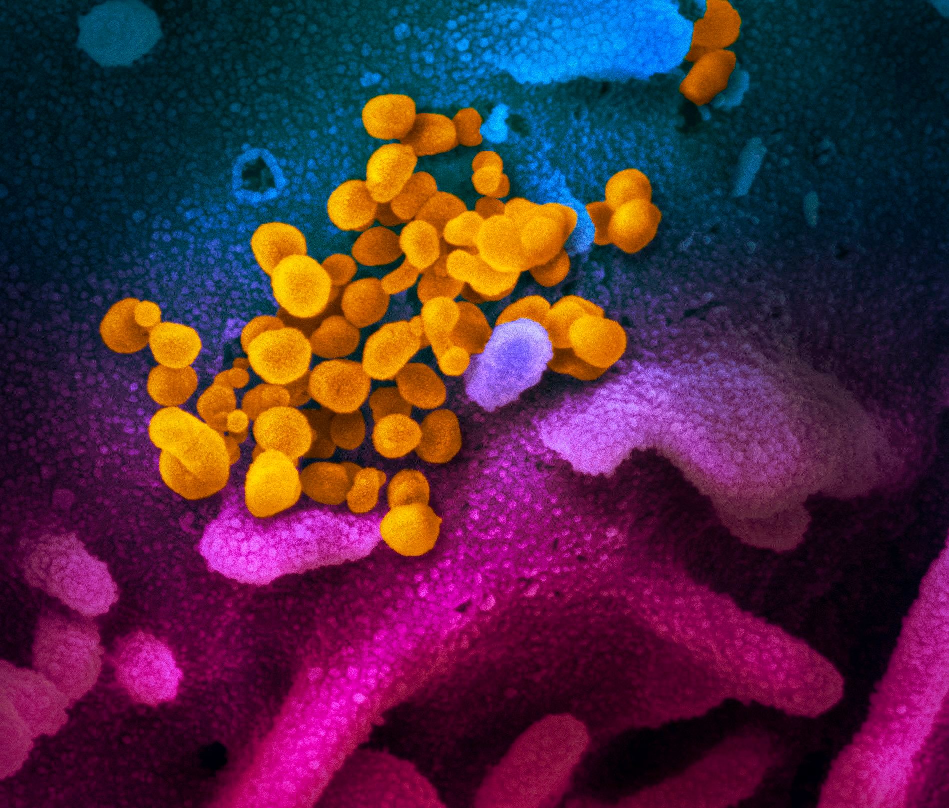 National Institutes of Health taken with a scanning electron microscope shows SARS-CoV-2 (yellow)—also known as 2019-nCoV, the virus that causes COVID-19. (AFP Photo)