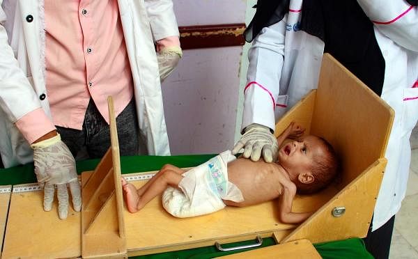 A Yemeni child suffering from malnutrition is measured at a treatment centre in Yemen. Credit: AFP