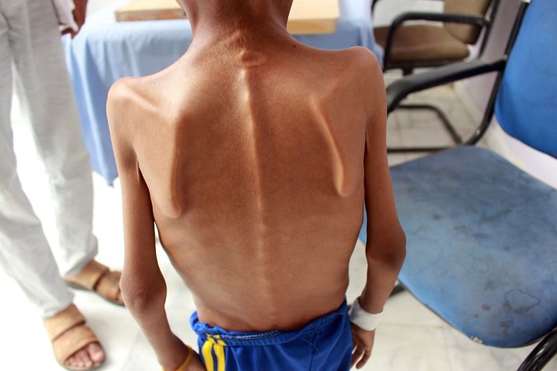 Malnourished boy Hassan Merzam Muhammad, is seen at a hospital in Aslam district of Hajjah province. Credits: Reuters Photo