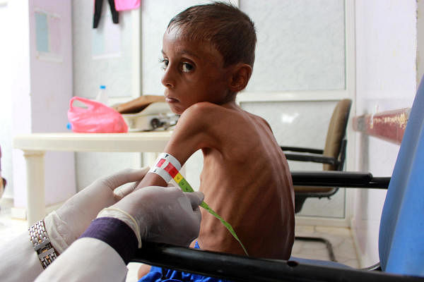 Doctor measure the arm of malnourished boy. Credit: Reuters