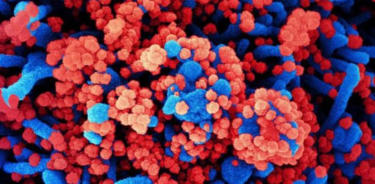 A colourized scanning electron micrograph of a cell (blue) heavily infected with SARS-CoV-2 virus particles (red), isolated from a patient sample. Credit: AFP