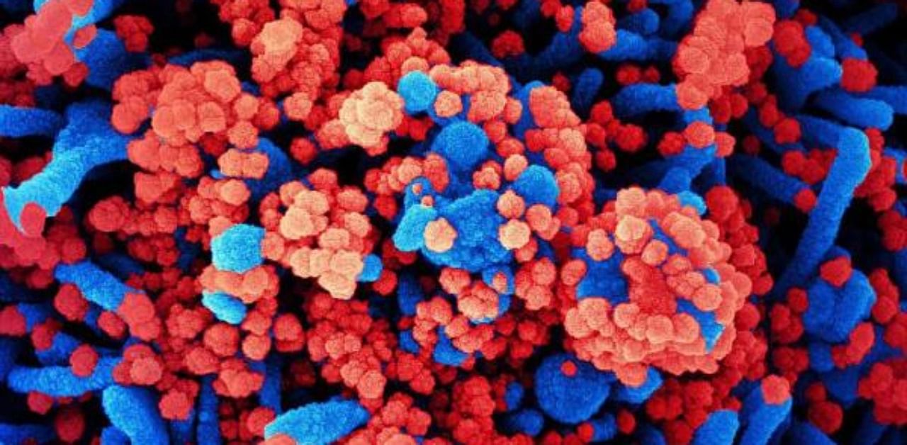 A colorized scanning electron micrograph of a cell (blue) heavily infected with SARS-CoV-2 virus particles (red), isolated from a patient sample. Credit: AFP
