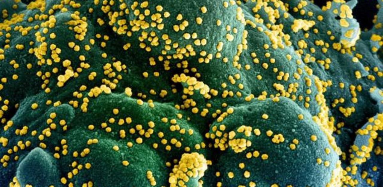 A colorized scanning electron micrograph of an apoptotic cell (blue/green) heavily infected with SARS-COV-2 virus particles (yellow), isolated from a patient sample. Credit: AFP