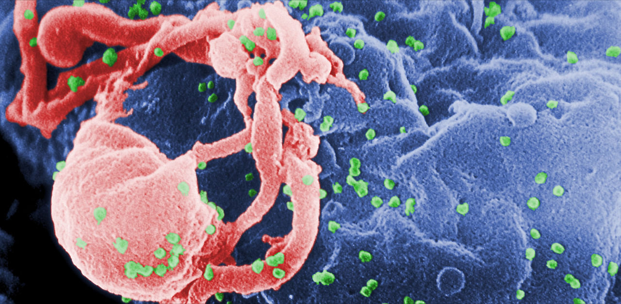 This scanning electron microscopic (SEM) image shows the presence of numerous human immunodeficiency virus-1 (HIV-1) virions (spherical in appearance) budding from a cultured human lymphocytes in this 1989 image obtained from Centers for Disease Control and Prevention. Credit: Reuters Photo