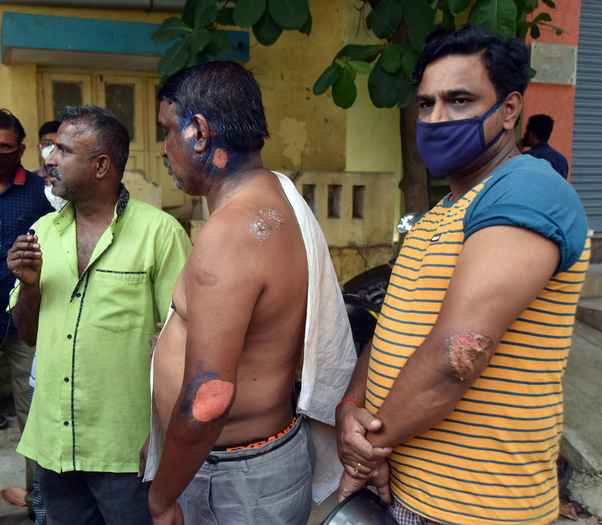 Residents show the burn injuries that they sustained in the fire accident at Hosaguddadahalli, Mysuru Road, Bengaluru, on Wednesday. DH PHOTO/ANUP RAGH T