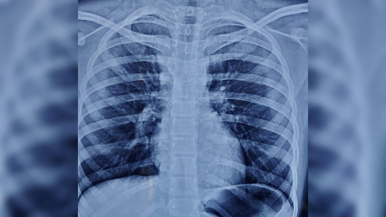 An x-ray of the chest revealed a metallic foreign body in the lower airway on the left side. Credit: Zen Multispeciality Hospital