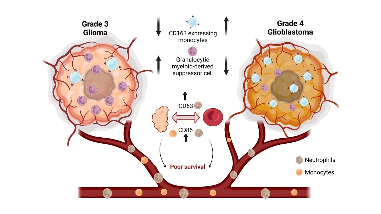 A comparison of monocyte and neutrophil phenotype in grade four and grade three gliomas. Credit: IISc