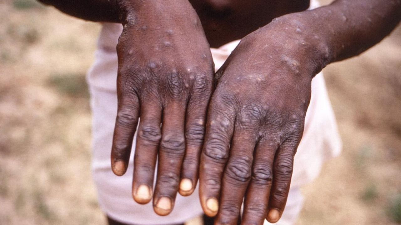 An image created during an investigation into an outbreak of monkeypox, which took place in the Democratic Republic of the Congo (DRC), 1996 to 1997, shows the hands of a patient with a rash due to monkeypox. Credit: Reuters photo/CDC