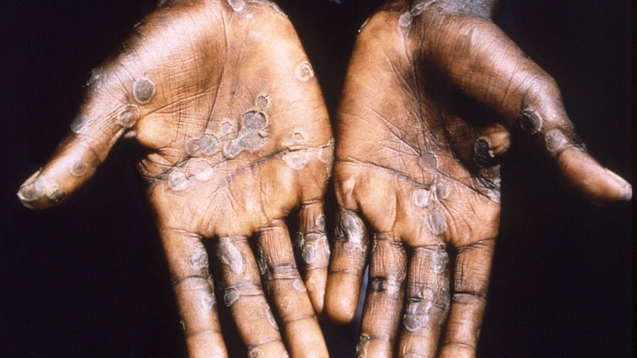Monkeypox is an uncommon disease that usually causes symptoms of fever, muscle aches, swollen lymph nodes and a chickenpox-like rash on the hands and face. Credit: Reuters photo