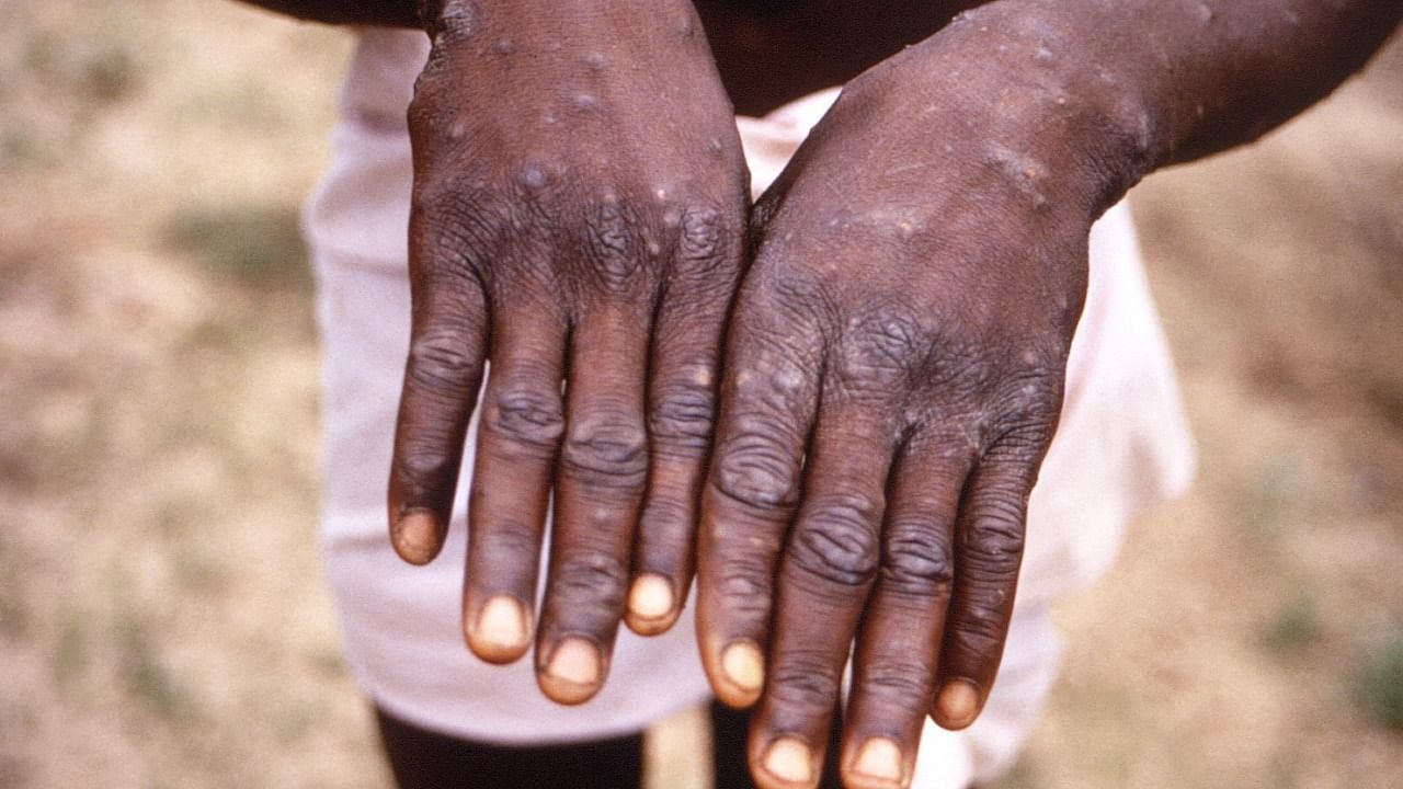 A CDC image shows a rash on a monkeypox patient. Credit: CDC/Brian W.J. Mahy/Handout via REUTERS