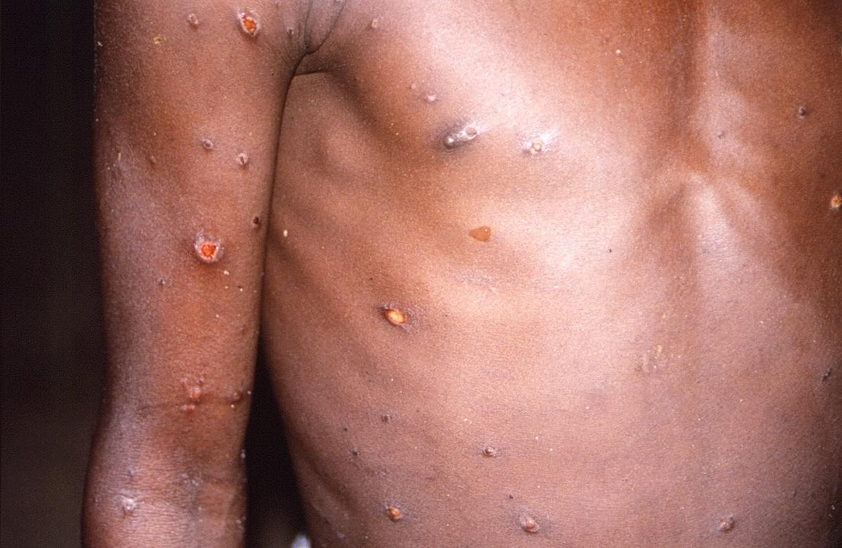 Monkeypox typically presents clinically with fever, rash and swollen lymph nodes. Credit: Reuters Photo