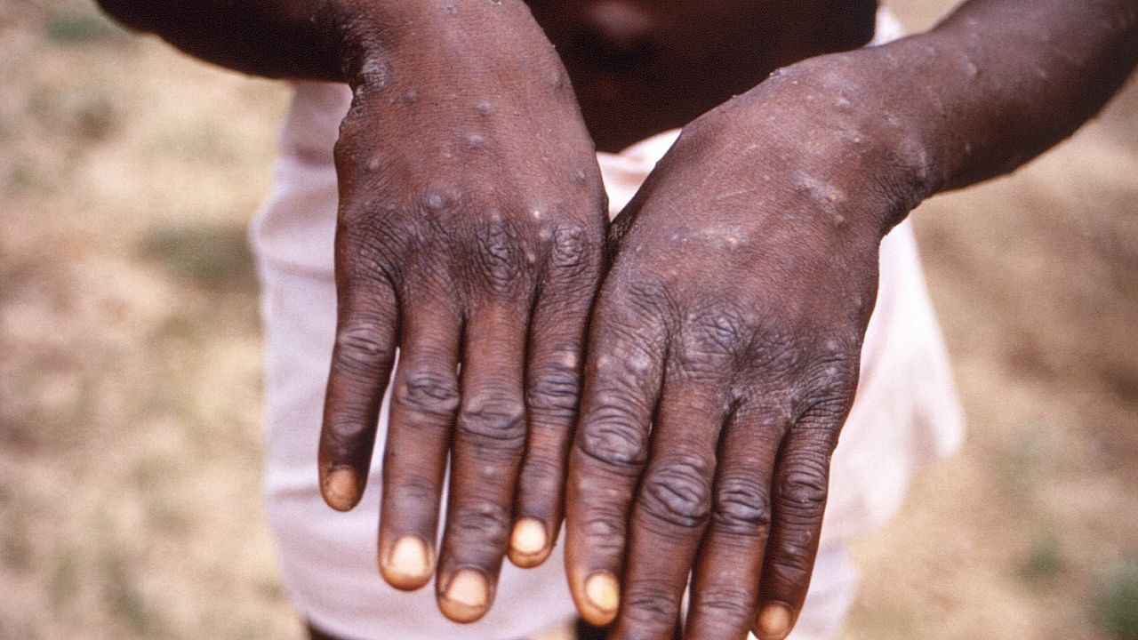 Monkeypox is a self-limiting disease and symptoms may stay up to four weeks. Credit: AP Photo