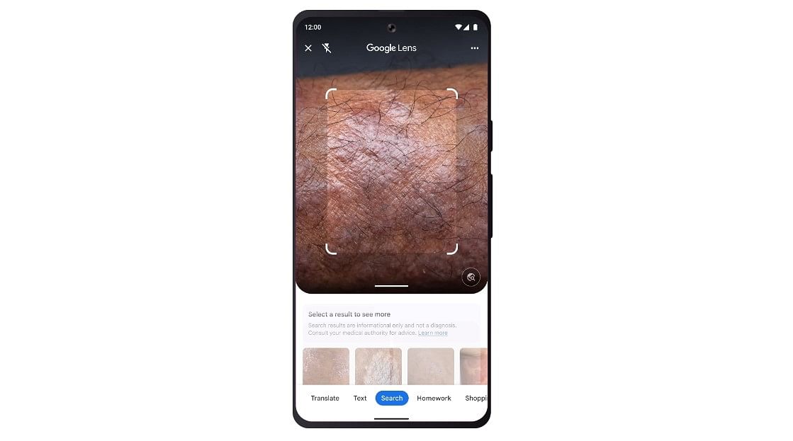 Google Lens feature gets skin condition detection feature. Credit: Google