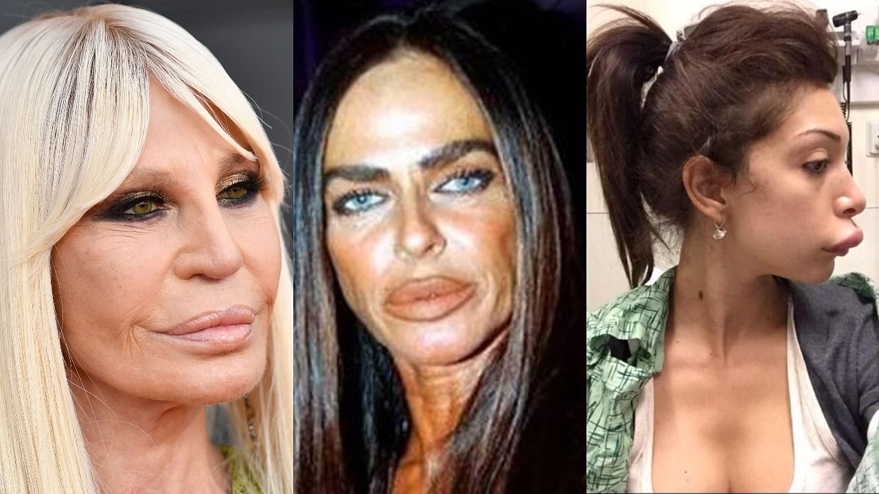In Pics | Stars with cosmetic surgeries gone wrong